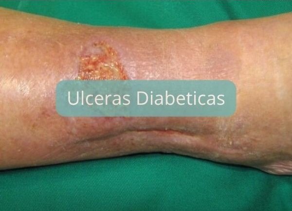 enfermera curaciones a domicilio